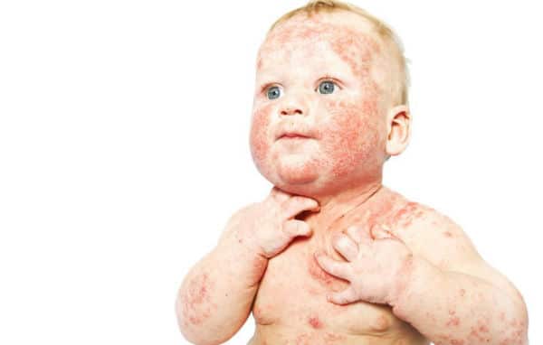 Atopijski Dermatitis Kod Djece Slike